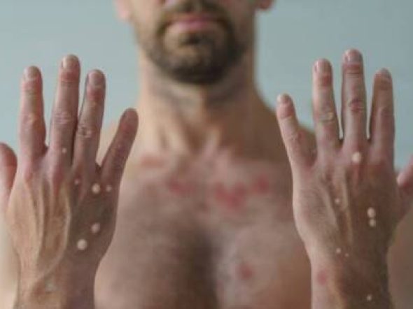 monkeypox-image-653812275a949-600x300.jpg