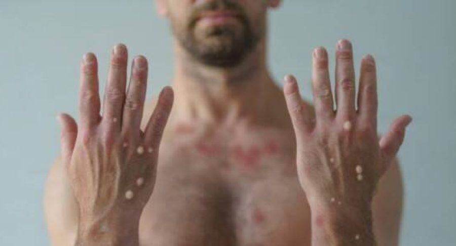 monkeypox-image-653812275a949-600x300.jpg